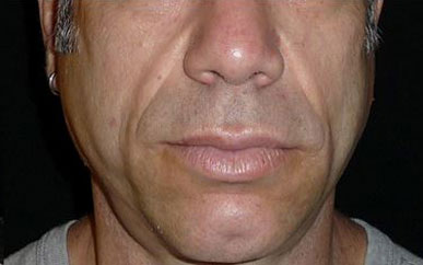 A close view of a man's lower face shows hollow cheeks and folds beside the mouth, consistent with facial volume loss.