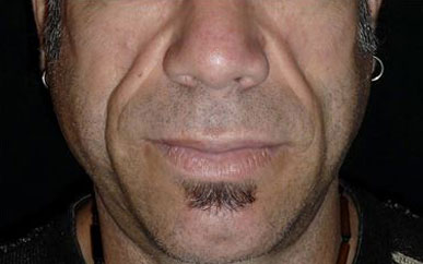 A close-up of a man's lower face shows hollow cheeks, fine lines and a small area of facial hair beneath his lower lip.