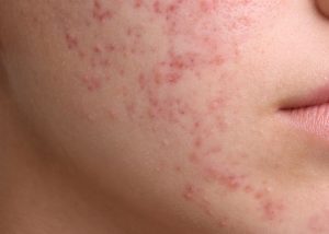 urepublic-Everything-you-need-to-know-about-acne-scars